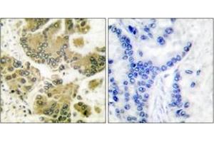 Immunohistochemistry analysis of paraffin-embedded human breast carcinoma tissue, using SGK (Ab-422) Antibody. (SGK1 抗体  (AA 381-430))