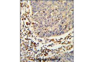 Formalin-fixed and paraffin-embedded human lung carcinoma reacted with SH2D1B Antibody , which was peroxidase-conjugated to the secondary antibody, followed by DAB staining. (SH2D1B 抗体  (AA 65-92))