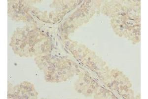 Immunohistochemistry of paraffin-embedded human prostate cancer using ABIN7171939 at dilution of 1:100 (TTC38 抗体  (AA 2-200))