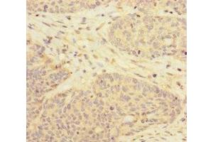 Immunohistochemistry of paraffin-embedded human ovarian cancer using ABIN7170629 at dilution of 1:100 (RBM17 抗体  (AA 1-240))