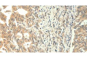 Immunohistochemistry of paraffin-embedded Human gastric cancer using TRPM5 Polyclonal Antibody at dilution of 1:60 (TRPM5 抗体)
