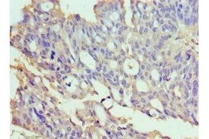 Immunohistochemistry of paraffin-embedded human endometrial cancer using ABIN7172022 at dilution of 1:100 (TXNRD2 抗体  (AA 100-310))