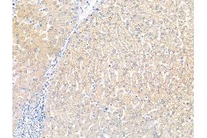 ABIN7094601 and ABIN7098651 at 1/100 staining Human liver cancer and adjacent normal tissues by IHC-P.