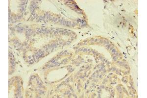 Immunohistochemistry of paraffin-embedded human breast cancer using ABIN7166957 at dilution of 1:100 (GDI2 抗体  (AA 1-445))