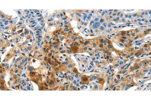 Immunohistochemistry of paraffin-embedded Human lung cancer tissue using COG1 Polyclonal Antibody at dilution 1:60 (COG1 抗体)