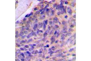 Immunohistochemical analysis of Galectin 8 staining in human breast cancer formalin fixed paraffin embedded tissue section. (LGALS8 抗体  (Center))