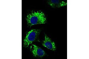 Immunohistochemical analysis of paraffin-embedded bladder cancer tissues using IL2RA antibody with DAB staining. (CD25 抗体  (AA 34-139))