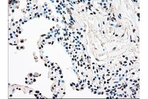 Immunohistochemical staining of paraffin-embedded Adenocarcinoma of breast tissue using anti-RAD9A mouse monoclonal antibody. (RAD9A 抗体)