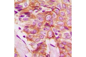 Immunohistochemical analysis of Frizzled 8 staining in human breast cancer formalin fixed paraffin embedded tissue section. (FZD8 抗体  (C-Term))