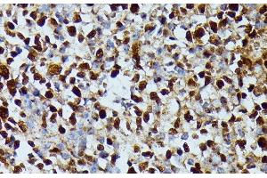 Immunohistochemistry of paraffin-embedded Human appendix using DUT Polyclonal Antibody at dilution of 1:100 (40x lens). (Deoxyuridine Triphosphatase (DUT) 抗体)