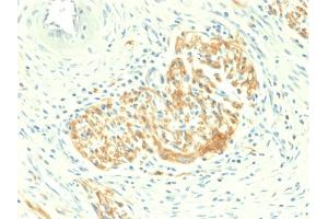 Formalin-fixed, paraffin-embedded human Colon Carcinoma stained with CD56 Rabbit Recombinant Monoclonal Antibody (NCAM1/2217R). (Recombinant CD56 抗体)