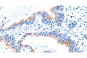 Immunohistochemistry of paraffin-embedded Human colon cancer tissue using SMG8 Polyclonal Antibody at dilution 1:50 (SMG8 抗体)
