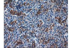 Immunohistochemical staining of paraffin-embedded Adenocarcinoma of colon using anti-KRT18 (ABIN2452646) mouse monoclonal antibody. (Cytokeratin 18 抗体  (AA 69-372))