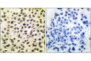 Immunohistochemistry analysis of paraffin-embedded human breast carcinoma tissue, using Fos Antibody. (c-FOS 抗体  (AA 1-50))