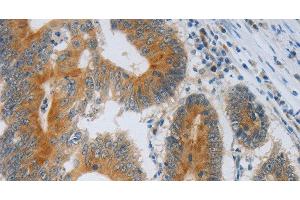 Immunohistochemistry of paraffin-embedded Human colon cancer using F2R Polyclonal Antibody at dilution of 1:40 (PAR1 抗体)