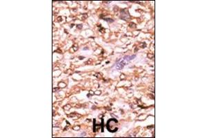Formalin-fixed and paraffin-embedded human cancer tissue reacted with the primary antibody, which was peroxidase-conjugated to the secondary antibody, followed by AEC staining. (p53 抗体  (pThr18))