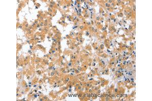 Immunohistochemistry of Human liver cancer using CDR2 Polyclonal Antibody at dilution of 1:60 (CDR2 抗体)