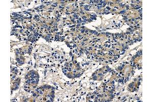ABIN7096959 and ABIN7101026 at 1/100 staining human colorectal cancer by IHC-P.
