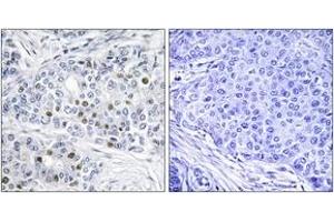 Immunohistochemistry analysis of paraffin-embedded human breast carcinoma tissue, using Retinoblastoma (Ab-821) Antibody. (Retinoblastoma Protein (Rb) 抗体  (AA 791-840))