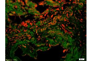 Formalin-fixed and paraffin-embedded human colon carcinoma labeled with Anti-VE Cadherin/VECD/CD144 Polyclonal Antibody, Unconjugated (ABIN1387250) 1:200, overnight at 4°C, The secondary antibody was Goat Anti-Rabbit IgG, Cy3 conjugated used at 1:200 dilution for 40 minutes at 37°C. (Cadherin 5 抗体  (AA 251-320))