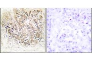 Immunohistochemistry analysis of paraffin-embedded human breast carcinoma tissue, using TCTP Antibody. (TPT1 抗体  (AA 71-120))