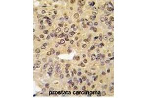 Formalin-fixed and paraffin-embedded human prostata carcinoma tissue reacted with MEN1 Antibody  (ABIN391613 and ABIN2841534) , which was peroxidase-conjugated to the secondary antibody, followed by DAB staining. (Menin 抗体  (AA 113-144))