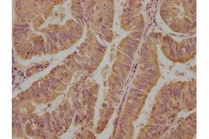 IHC image of ABIN7152176 diluted at 1:100 and staining in paraffin-embedded human endometrial cancer performed on a Leica BondTM system. (EIF4G2 抗体  (AA 706-907))