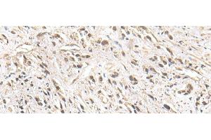 Immunohistochemistry of paraffin-embedded Human prost ate cancer tissue using ZNF281 Polyclonal Antibody at dilution of 1:30(x200) (ZNF281 抗体)