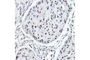 Immunohistochemistry of paraffin-embedded human esophageal cancer using MDC1 Rabbit pAb (ABIN6134688, ABIN6143659, ABIN6143661 and ABIN6216452) at dilution of 1:150 (40x lens). (MDC1 抗体  (AA 1-100))