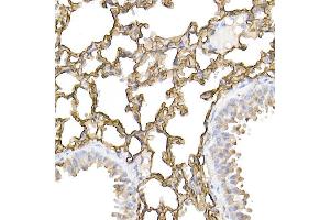 Immunohistochemistry of paraffin-embedded human lung cancer using ICAM-1/CD54 Rabbit pAb (ABIN6129231, ABIN6142118, ABIN6142120 and ABIN6221235) at dilution of 1:100 (40x lens). (ICAM1 抗体  (AA 250-480))