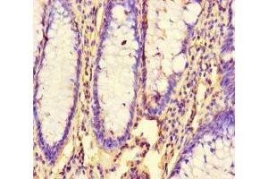 Immunohistochemistry of paraffin-embedded human colon cancer using ABIN7154592 at dilution of 1:100 (RHEB 抗体  (AA 1-182))