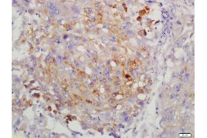 Formalin-fixed and paraffin embedded human lung carcinoma labeled with Anti-LMP7 Polyclonal Antibody, Unconjugated  at 1:200 followed by conjugation to the secondary antibody and DAB staining. (PSMB8 抗体  (AA 171-272))