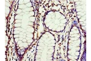 Immunohistochemistry of paraffin-embedded human colon cancer using ABIN7147915 at dilution of 1:100 (CLDN8 抗体  (AA 141-225))