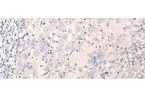 Immunohistochemistry of paraffin-embedded Human cervical cancer tissue using LILRA2 Polyclonal Antibody at dilution of 1:40(x200)