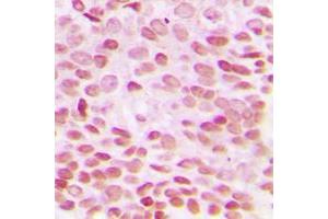 Immunohistochemical analysis of GADD153 staining in human breast cancer formalin fixed paraffin embedded tissue section. (DDIT3 抗体  (N-Term))