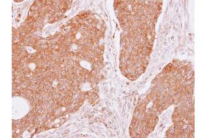 IHC-P Image DIAPH1 antibody [C2C3], C-term detects DIAPH1 protein at cytoplasm on human colon carcinoma by immunohistochemical analysis. (DIAPH1 抗体  (C-Term))
