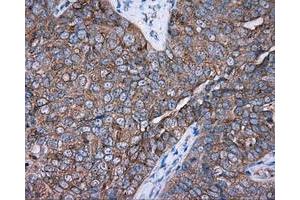Immunohistochemical staining of paraffin-embedded Adenocarcinoma of colon tissue using anti-PRKAR2A mouse monoclonal antibody. (PRKAR2A 抗体)