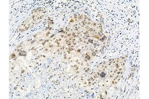 Phospho-Histone H3 (Thr3) Antibody at 1/100 staining Human ovarian cancer by IHC-P. (Histone 3 抗体  (H3T3ph))