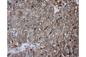 Immunohistochemical staining of paraffin-embedded Adenocarcinoma of ovary tissue using anti-PRKAR2A mouse monoclonal antibody. (PRKAR2A 抗体)