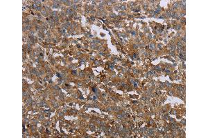 Immunohistochemistry of Human liver cancer using GCK Polyclonal Antibody at dilution of 1:40 (GCK 抗体)