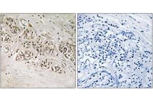 Immunohistochemistry analysis of paraffin-embedded human breast carcinoma, using RAD54B Antibody. (RAD54B 抗体  (AA 241-290))