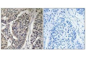 Immunohistochemical analysis of paraffin-embedded human breast carcinoma tissue, using p130 Cas (Phospho-Tyr410) antibody (left)or the same antibody preincubated with blocking peptide (right). (BCAR1 抗体  (pTyr410))