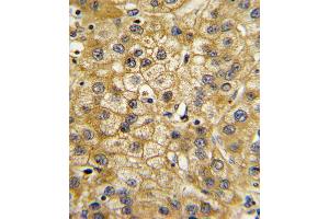 Formalin-fixed and paraffin-embedded human hepatocarcinoma with ADIPOR1 Antibody , which was peroxidase-conjugated to the secondary antibody, followed by DAB staining. (Adiponectin Receptor 1 抗体  (C-Term))