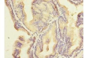 Immunohistochemistry of paraffin-embedded human prostate cancer using ABIN7176433 at dilution of 1:100 (ZNF614 抗体  (AA 1-198))