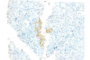 ABIN7094529 and ABIN7098578 at 1/100 staining Human lung cancer by IHC-P. (STIL 抗体  (C-Term))