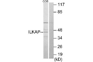 Immunohistochemistry analysis of paraffin-embedded human colon carcinoma tissue using ILKAP antibody. (ILKAP 抗体)