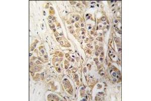 Formalin-fixed and paraffin-embedded human breast carcinoma tissue reacted with CLIC4 antibody, which was peroxidase-conjugated to the secondary antibody, followed by DAB staining. (CLIC4 抗体)