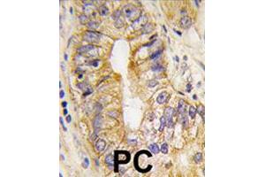 Formalin-fixed and paraffin-embedded human prostate carcinoma tissue reacted with PDGFRA polyclonal antibody  , which was peroxidase-conjugated to the secondary antibody, followed by DAB staining. (PDGFRA 抗体  (Tyr768))