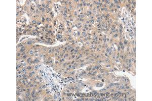 Immunohistochemistry of Human ovarian cancer using PRKD1 Polyclonal Antibody at dilution of 1:70 (PKC mu 抗体)