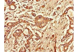 Immunohistochemistry of paraffin-embedded human pancreatic cancer using ABIN7172270 at dilution of 1:100 (TLR3 抗体  (AA 135-297))
